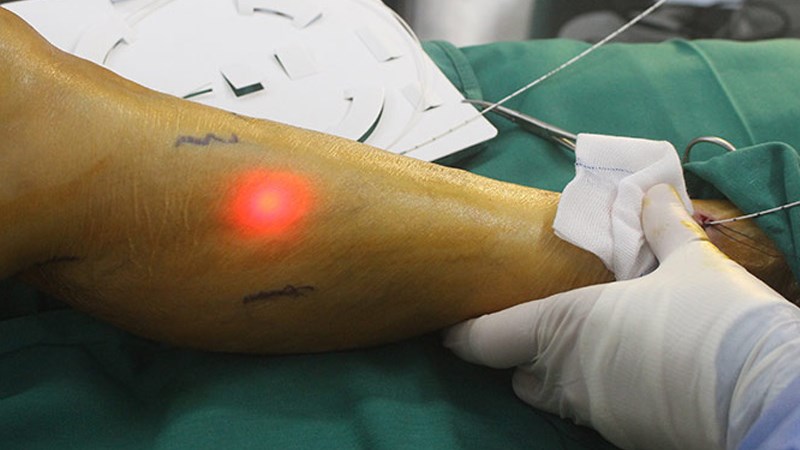 Phẫu thuật laser là phương pháp hiện đại giúp cải thiện suy giãn tĩnh mạch