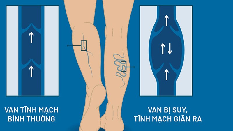 Nguyên nhân chính gây suy giãn tĩnh mạch