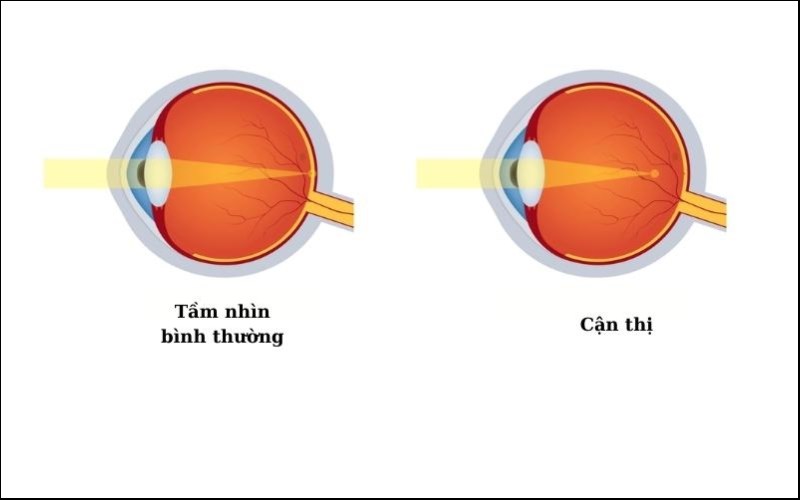 Bệnh cận thị là gì? Nguyên nhân, dấu hiệu và cách chữa cận thị