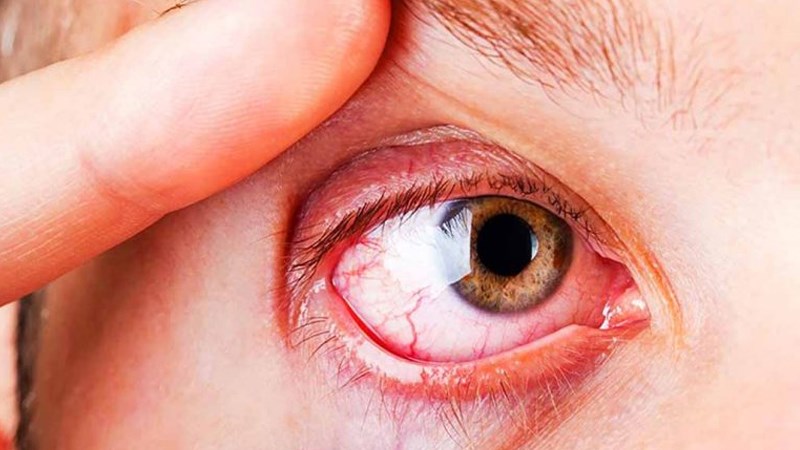 Đau mắt hột: Nguyên nhân, triệu chứng và cách chữa trị hiệu quả