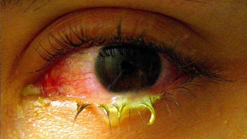 Chảy nước mắt có lẫn mủ trong bệnh đau mắt hột