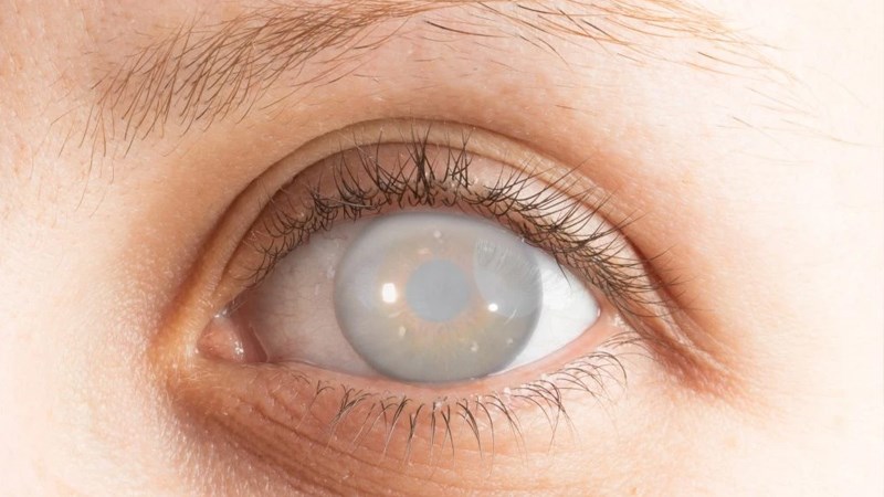 Suy giảm thị lực không phục hồi là biến chứng nguy hiểm trong bệnh đau mắt hột