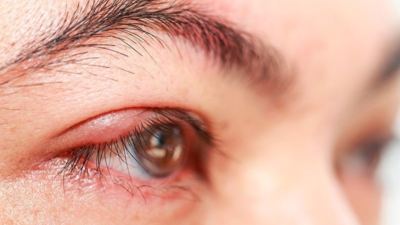 Ngứa, kích ứng và sưng mí mắt là dấu hiệu cảnh báo đau mắt hột