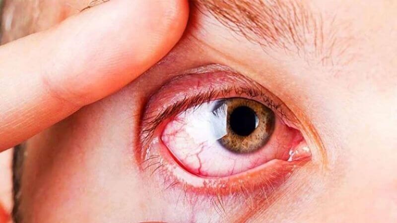 Sau phẫu thuật đục thủy tinh thể có thể gặp phải tình trạng viêm