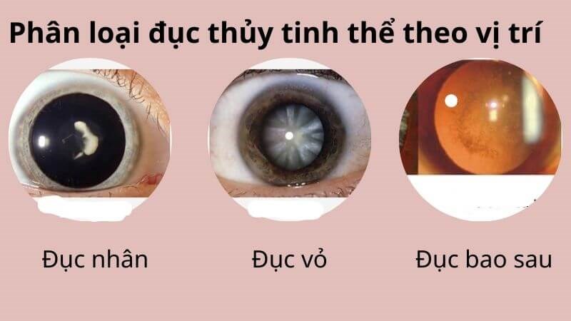 Phân loại đục thủy tinh thể do vị trí hình thành