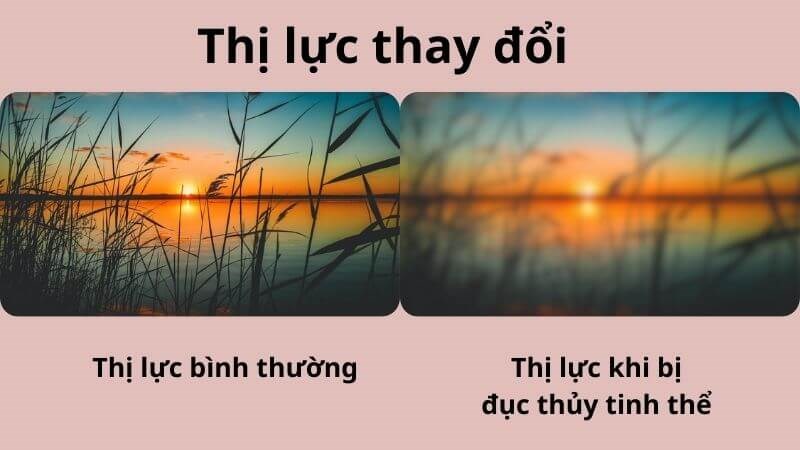 Đục thủy tinh thể gây ra nhìn mờ