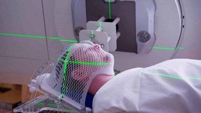 Xạ trị vùng đầu mặt cổ là một trong những yếu tố nguy cơ của đục thủy tinh thể