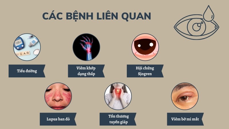 Khô mắt có thể là triệu chứng của một số bệnh tự miễn Khô mắt có thể là triệu chứng của một số bệnh tự miễn