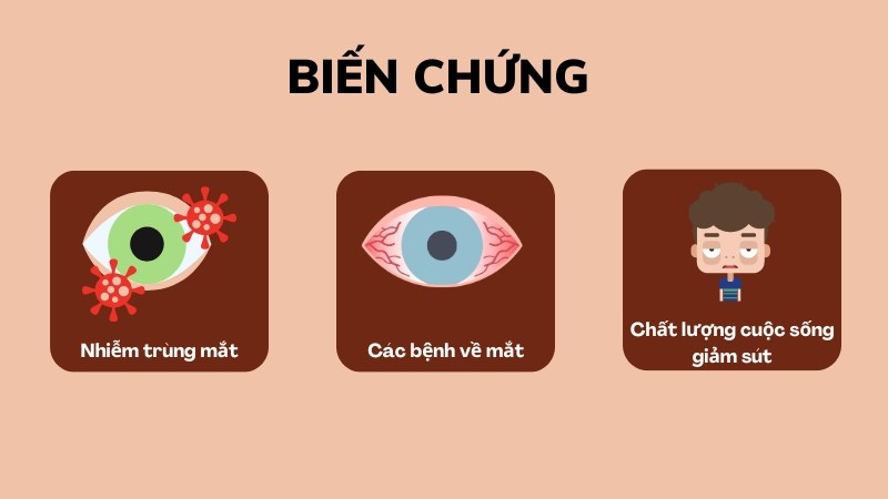 Khô mắt có thể tiến triển thành các biến chứng nghiêm trọng nếu không điều trị kịp thời Khô mắt có thể tiến triển thành các biến chứng nghiêm trọng nếu không điều trị kịp thời