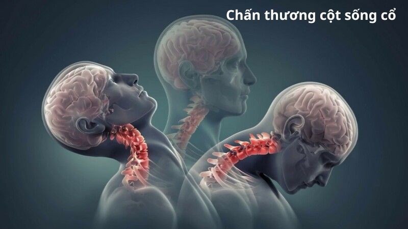 Chấn thương vùng cột sống cổ là một trong những nguyên nhân gây đau cổ gáy Chấn thương vùng cột sống cổ là một trong những nguyên nhân gây đau cổ gáy