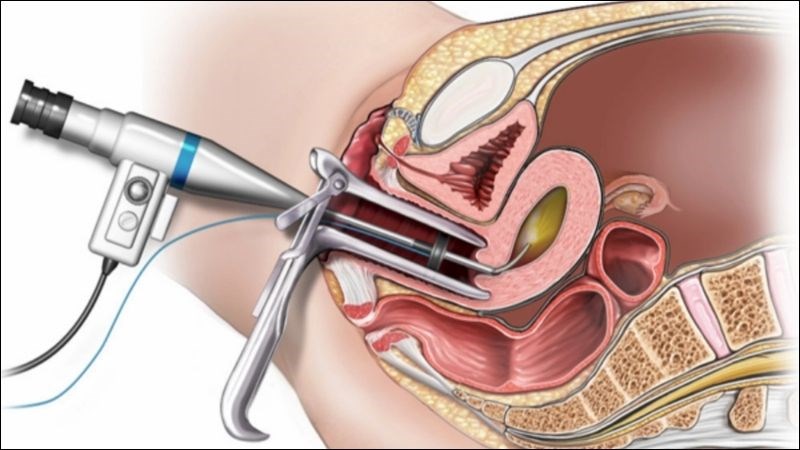 Điều trị polyp cổ tử cung bằng cách xoắn polyp ở đáy, cắt polyp bằng vòng điện