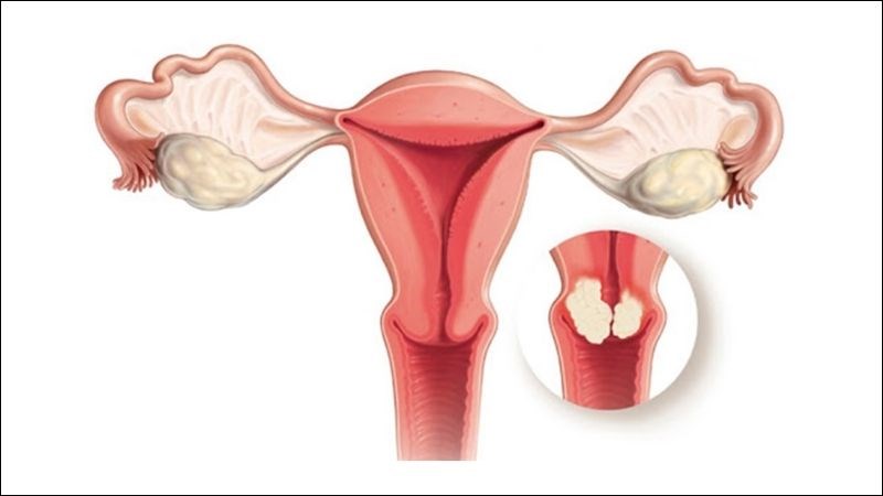 Polyp cổ tử cung có thể gây ra tình trạng vô sinh ở nữ giới 