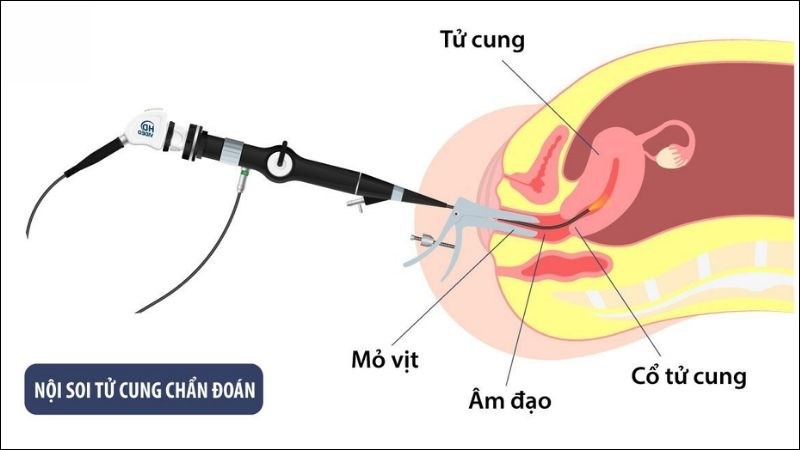 Soi tử cung để tìm ra các dấu hiệu bất thường ở tử cung