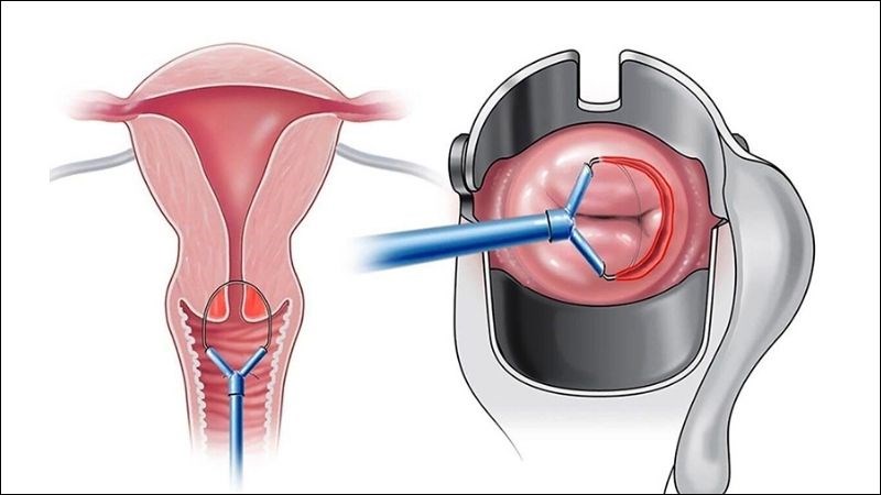 Sinh thiết là phương pháp lấy mô ở thành cổ tư cung để làm xét nghiệm 