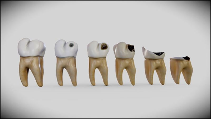 Sâu răng hình thành các lỗ hoặc rãnh trên bề mặt của răng