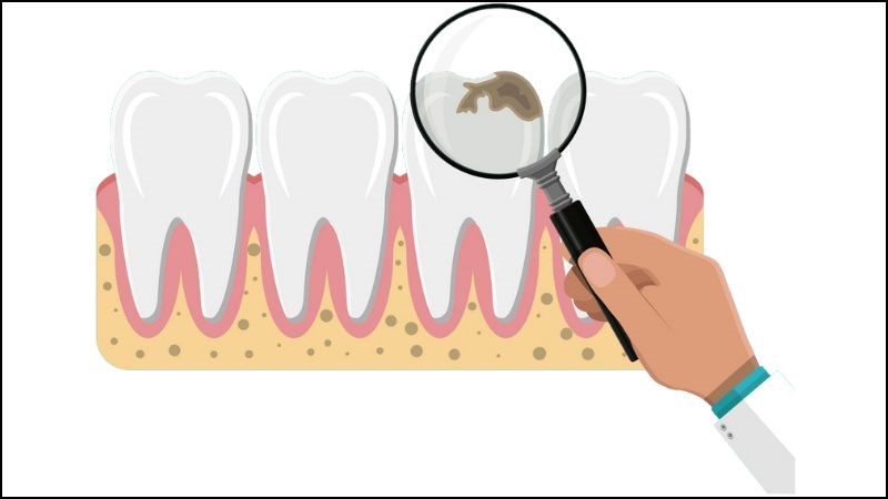 Bác sĩ có thể sử dụng các dụng cụ nha khoa chuyên dụng để thăm dò và kiểm tra răng bị sâu