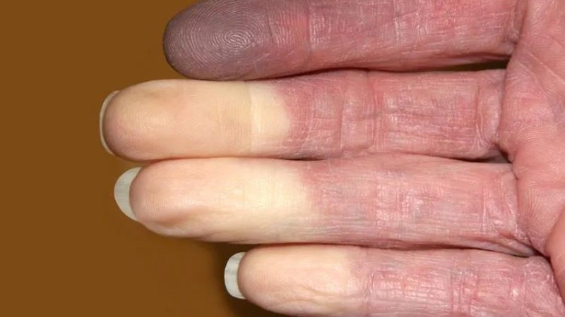 Xơ cứng bì làm các ngón chuyển sang màu trắng, xanh hoặc đỏ