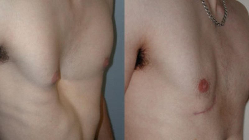 Phương pháp điều trị lõm ngực là gì? Có cần phẫu thuật hay không?
