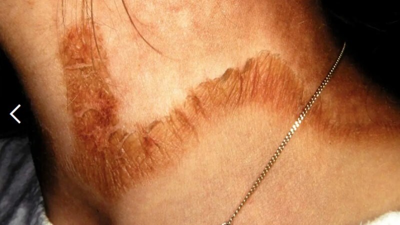 Bệnh Pellagra là một loại bệnh xuất hiện khi cơ thể bị rối loạn vitamin PP Bệnh Pellagra là gì? Nguyên nhân, triệu chứng và cách điều trị