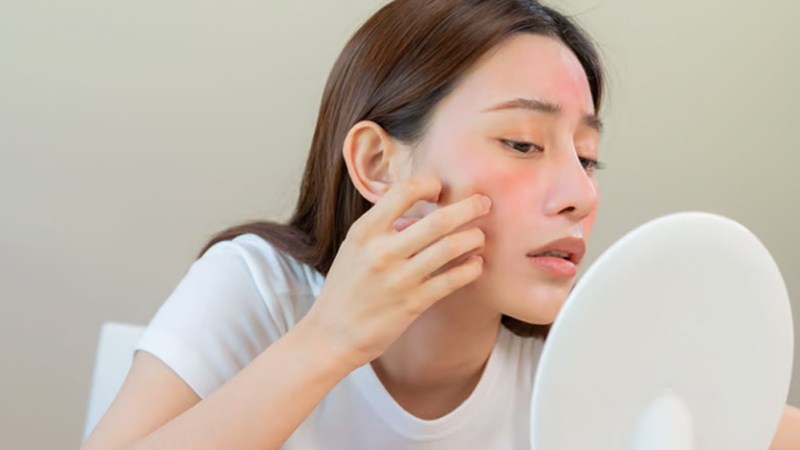 Lupus ban đỏ là một bệnh liên quan đến viêm khớp dạng thấp