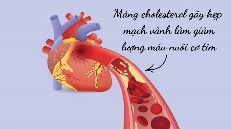 Mảng cholesterol gây hẹp mạch vành