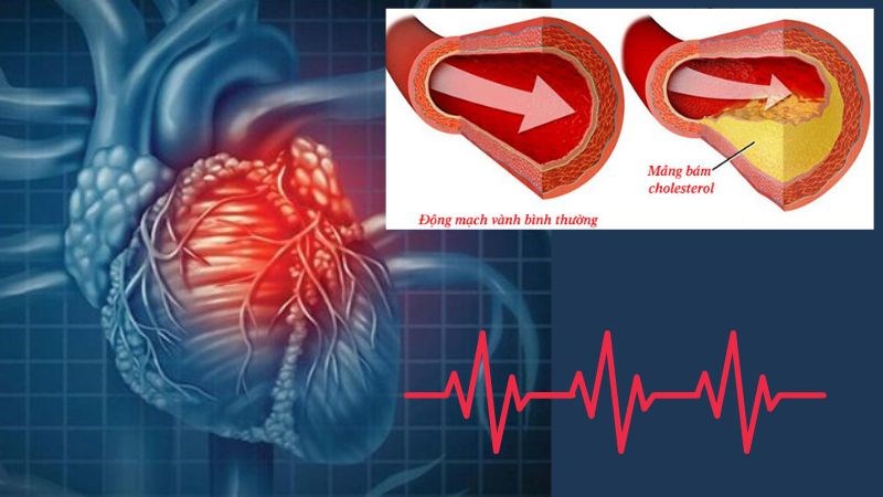 Mạch máu tim hẹp do tích tụ chất béo, cholesterol và các chất bám vào thành mạch