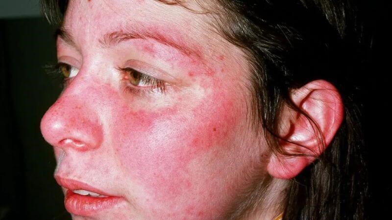 Bệnh nhược cơ làm tăng nguy cơ mắc bệnh lupus ban đỏ hệ thống