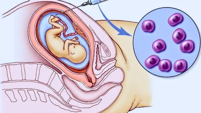 Sàng lọc trước sinh được thực hiện bằng cách xét nghiệm nước ối hoặc mẫu mô nhau thai