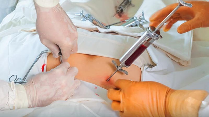Cấy ghép tế bào gốc hoặc tủy xương là cách chữa trị phổ biến cho bệnh hồng cầu hình liềm