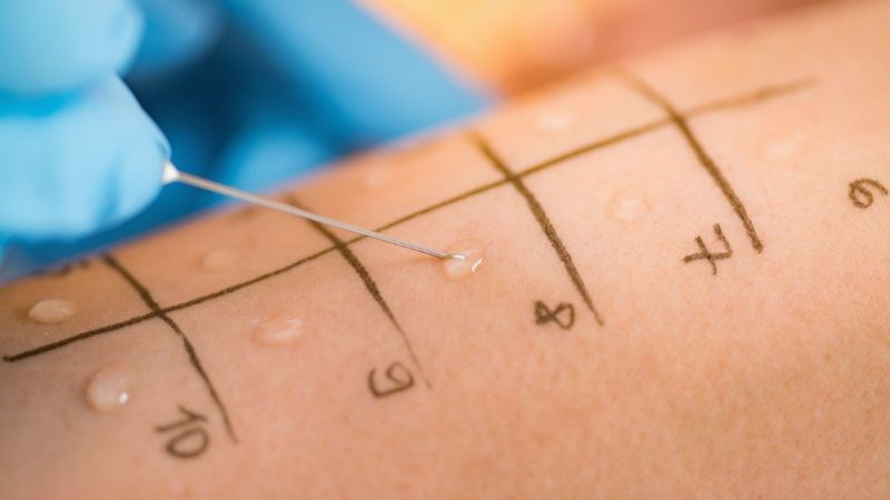 Test lẩy da tìm nguyên nhân gây dị ứng