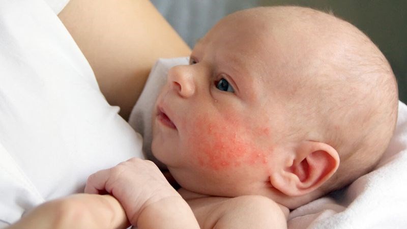 Triệu chứng thường gặp ở trẻ sơ sinh