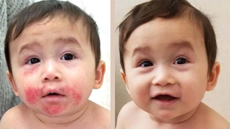 Triệu chứng thường gặp ở trẻ nhỏ