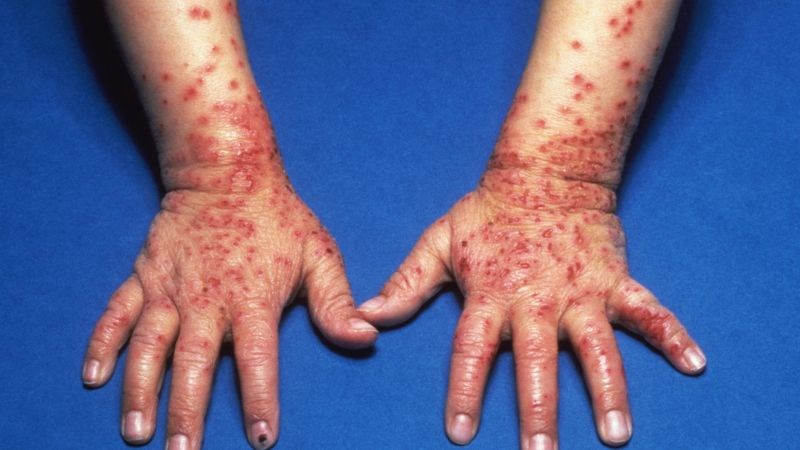 nhiễm trùng do virus Eczema Herpeticum