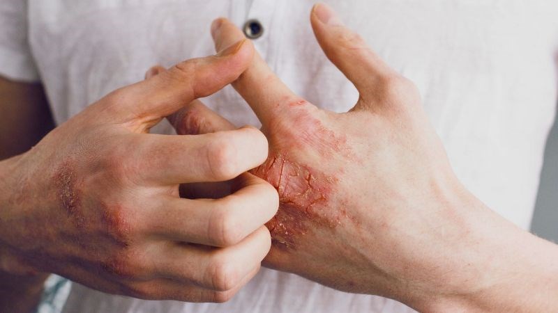 Ngứa là triệu chứng nổi bật của viêm da cơ địa
