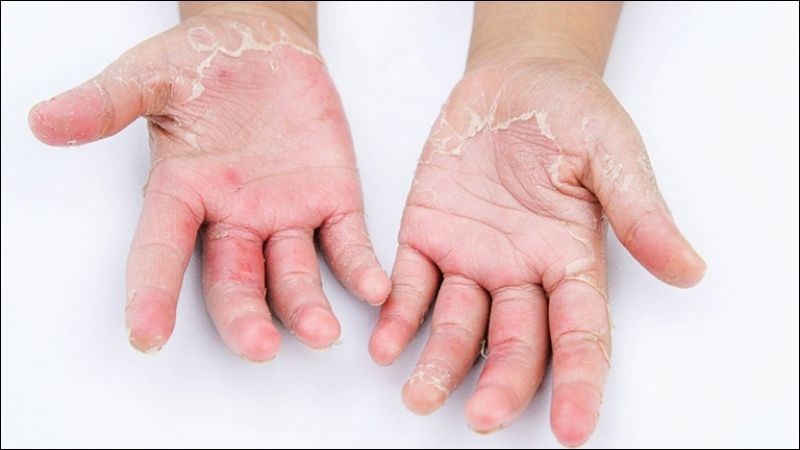 Bệnh á sừng là bệnh viêm da cơ địa