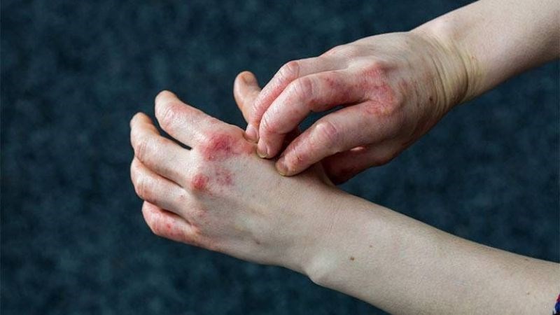 Yếu tố di truyền là nguyên nhân hàng đầu gây ra bệnh á sừng 