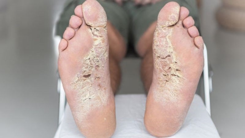 Biến chứng có bệnh á sừng có thể bị hoại tử da 