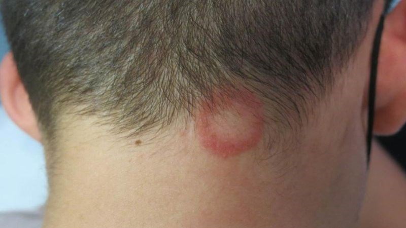Hắc lào xuất hiện trên da đầu là dấu hiệu cho thấy nên đến gặp bác sĩ