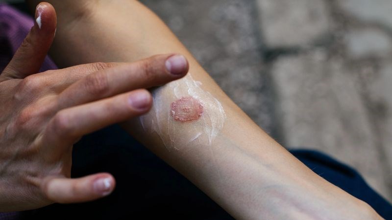 Khi bị hắc lào, bác sĩ thường sẽ kê cho bạn dạng thuốc bôi để điều trị bệnh