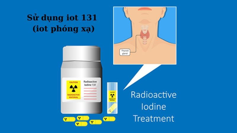 Sử dụng iot phóng xạ để tiêu diệt các tế bào tuyến giáp Sử dụng iot phóng xạ để tiêu diệt các tế bào tuyến giáp