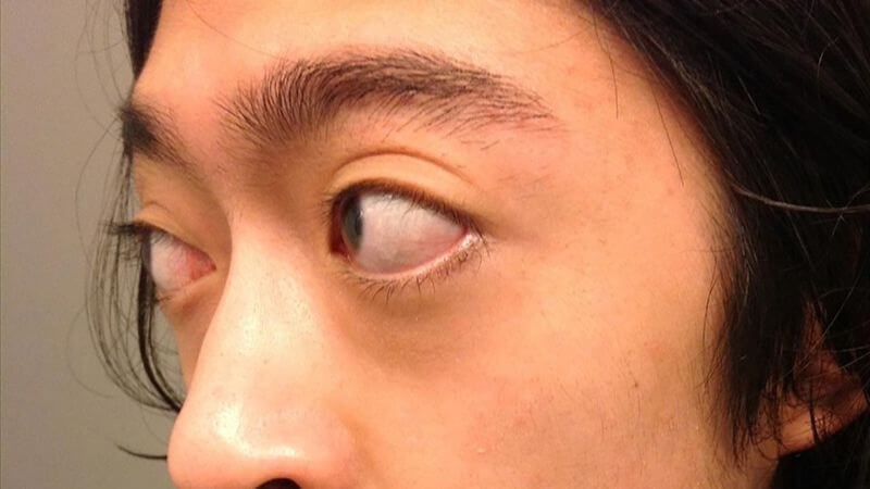 Các biến chứng về mắt của bệnh cường giáp Các biến chứng về mắt của bệnh cường giáp