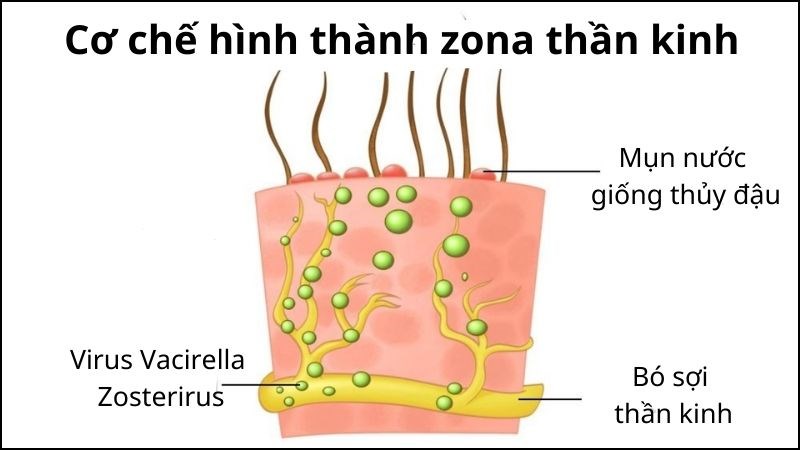 Bệnh zona thần kinh do virus Varicella zoster tồn tại ở dây thần kinh Bệnh zona thần kinh do virus Varicella zoster tồn tại ở dây thần kinh