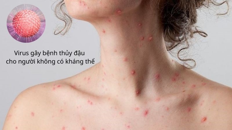 Bệnh zona thần kinh có thể lây cho người chưa có kháng thể kháng virus