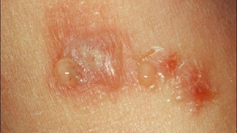 Bệnh Chàm Eczema Là Gì Cách Nhận Biết Và Điều Trị