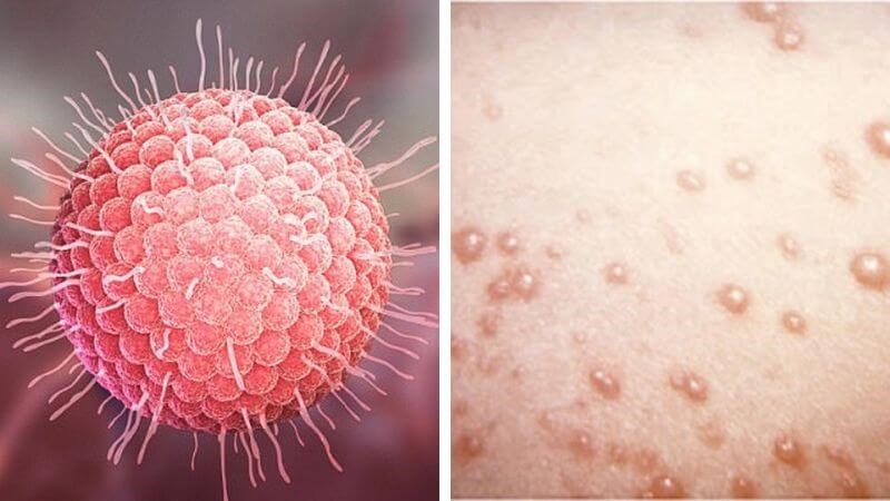 Bệnh thuỷ đậu: Nguyên nhân, triệu chứng và cách điều trị không để lại