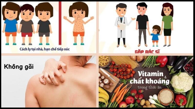 Lưu ý trong điều trị thuỷ đậu