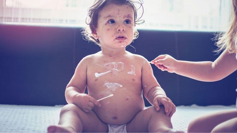 Bệnh Rubella: Nguyên nhân, triệu chứng và cách điều trị bệnh