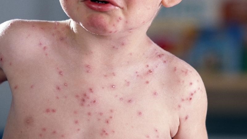 Những biến chứng có thể xảy ra khi mắc bệnh đậu mùa? 
