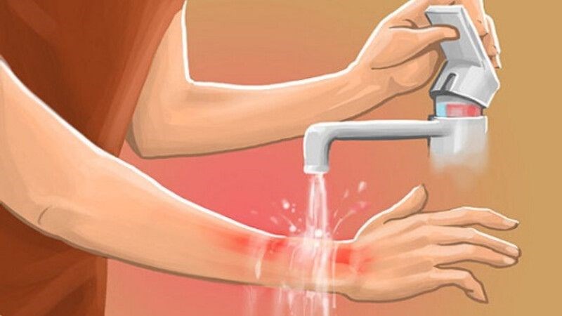 Bạn nên rửa sạch vết thương ngay sau khi bị chó cắn