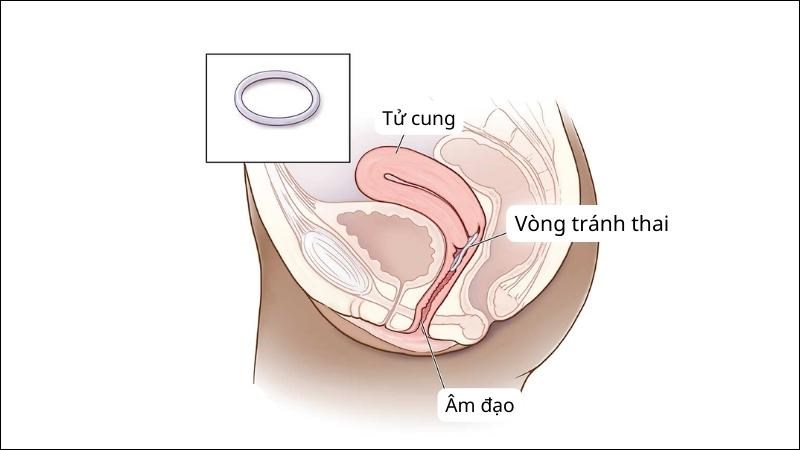 Vòng tránh thai kết cấu mềm để bạn có thể dễ dàng đưa vào âm đạo